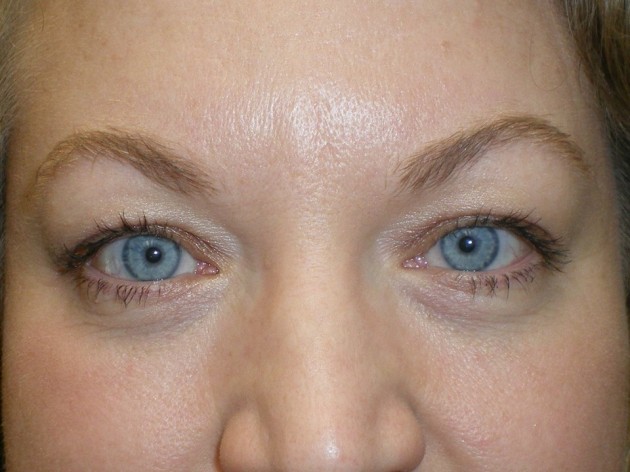 Upper Lid Blepharoplasty (upper eyelid lift)