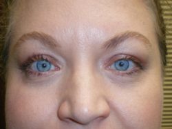 Upper Lid Blepharoplasty (upper eyelid lift)