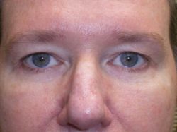 Upper Lid Blepharoplasty (upper eyelid lift)