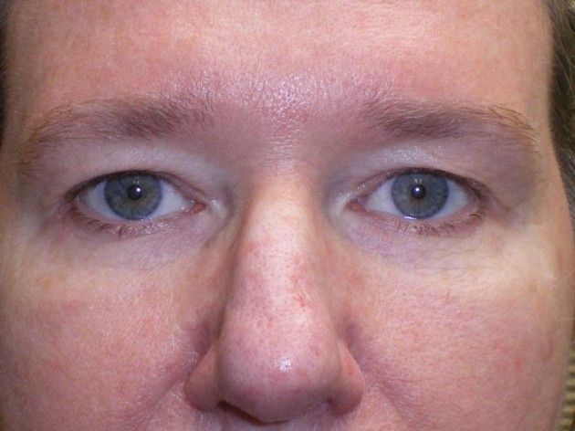 Upper Lid Blepharoplasty (upper eyelid lift)