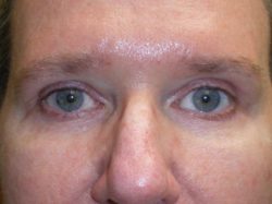 Upper Lid Blepharoplasty (upper eyelid lift)