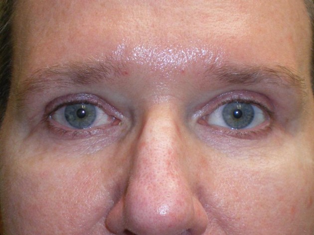 Upper Lid Blepharoplasty (upper eyelid lift)