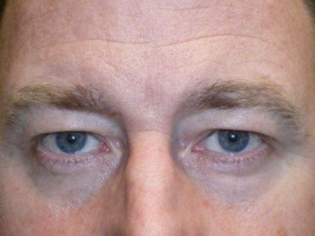 Upper Lid Blepharoplasty (upper eyelid lift)