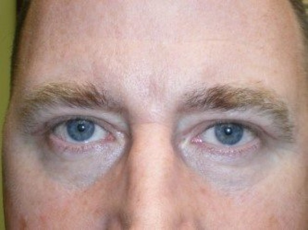 Upper Lid Blepharoplasty (upper eyelid lift)