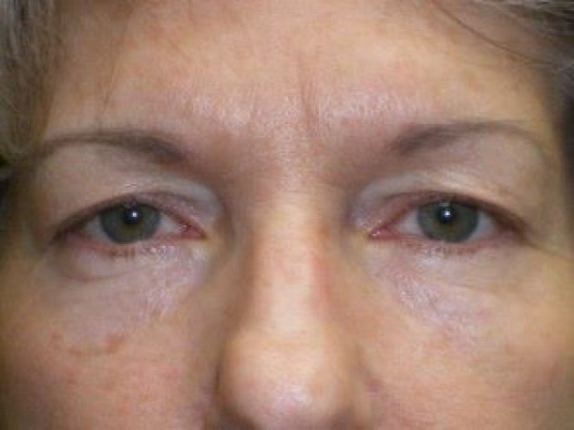 Upper Lid Blepharoplasty (upper eyelid lift)