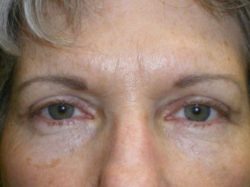 Upper Lid Blepharoplasty (upper eyelid lift)