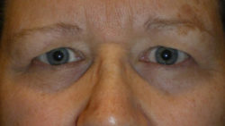 Combination Surgeries (eyelid lift and other)