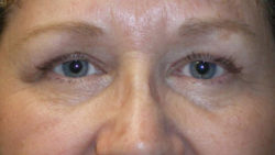 Combination Surgeries (eyelid lift and other)