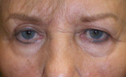 Combination Surgeries (eyelid lift and other)