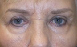 Combination Surgeries (eyelid lift and other)