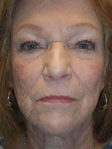 Combination Surgeries (eyelid lift and other) Case 72 Before Photo Combination Surgeries (eyelid lift and other)