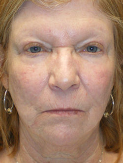 Combination Surgeries (eyelid lift and other)