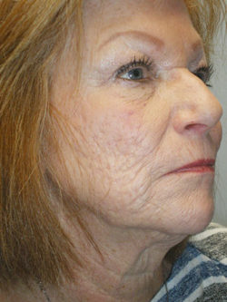 Combination Surgeries (eyelid lift and other)