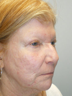 Combination Surgeries (eyelid lift and other)