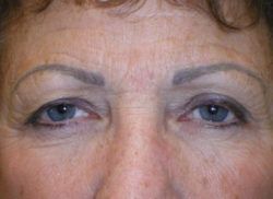 Combination Surgeries (eyelid lift and other)