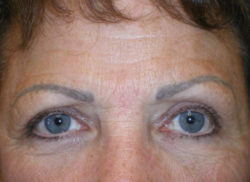 Combination Surgeries (eyelid lift and other)