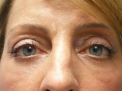 Combination Surgeries (eyelid lift and other)