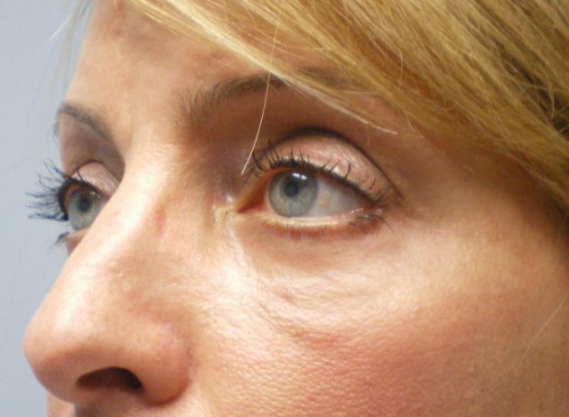 Combination Surgeries (eyelid lift and other)