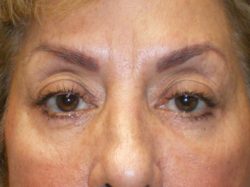 Combination Surgeries (eyelid lift and other)