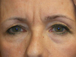 Combination Surgeries (eyelid lift and other)