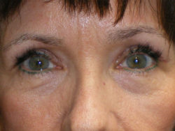 Combination Surgeries (eyelid lift and other)