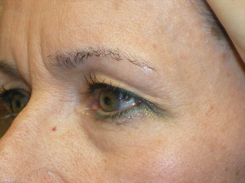 Combination Surgeries (eyelid lift and other)