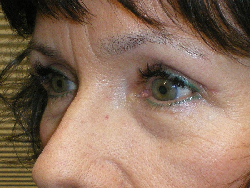 Combination Surgeries (eyelid lift and other)