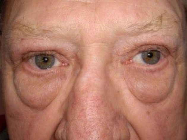 Lower Lid Blepharoplasty (lower eyelid eyelift)