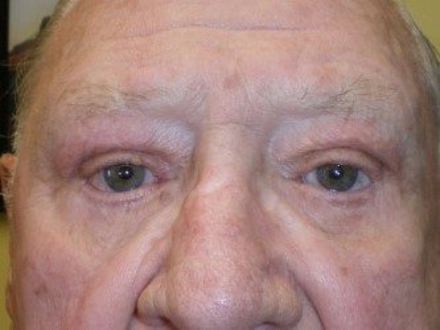 Lower Lid Blepharoplasty (lower eyelid eyelift)