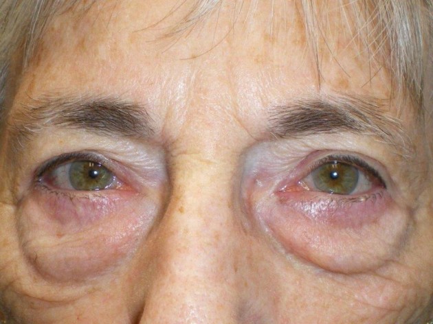 Lower Lid Blepharoplasty (lower eyelid eyelift) Case 105 Before Photo Lower Lid Blepharoplasty (lower eyelid eyelift)