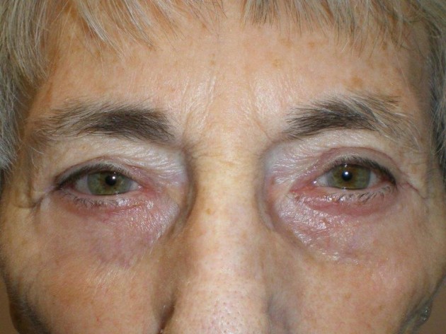 Lower Lid Blepharoplasty (lower eyelid eyelift) Case 105 After Photo Lower Lid Blepharoplasty (lower eyelid eyelift)