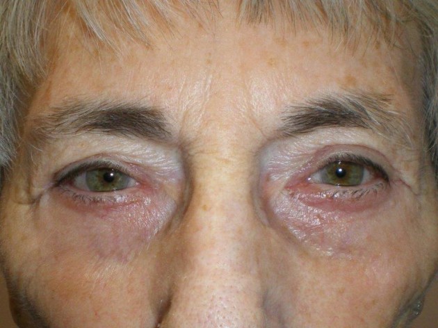 Lower Lid Blepharoplasty (lower eyelid eyelift)