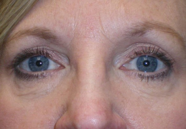 CO2 Laser Resurfacing (wrinkle/line reduction)