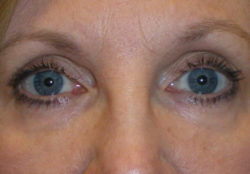 CO2 Laser Resurfacing (wrinkle/line reduction)