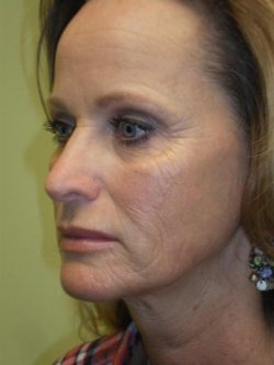 CO2 Laser Resurfacing (wrinkle/line reduction)