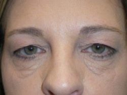 CO2 Laser Resurfacing (wrinkle/line reduction)