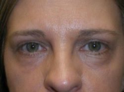 CO2 Laser Resurfacing (wrinkle/line reduction)