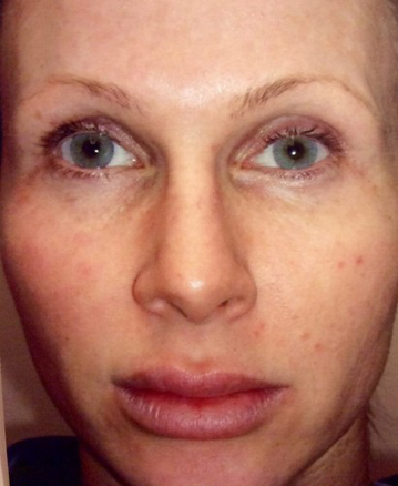 CO2 Laser Resurfacing (wrinkle/line reduction)