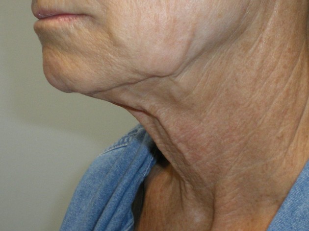 Face/Neck Lift