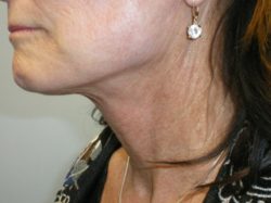 Face/Neck Lift