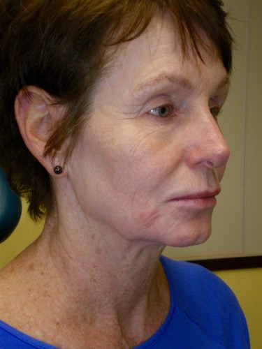 Before Brow/Forehead Lift Mini Facelift