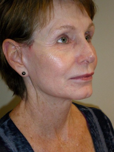 After Brow/Forehead Lift Mini Facelift