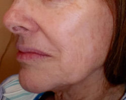 Face/Neck Lift