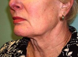 Face/Neck Lift