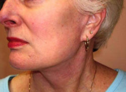 Face/Neck Lift