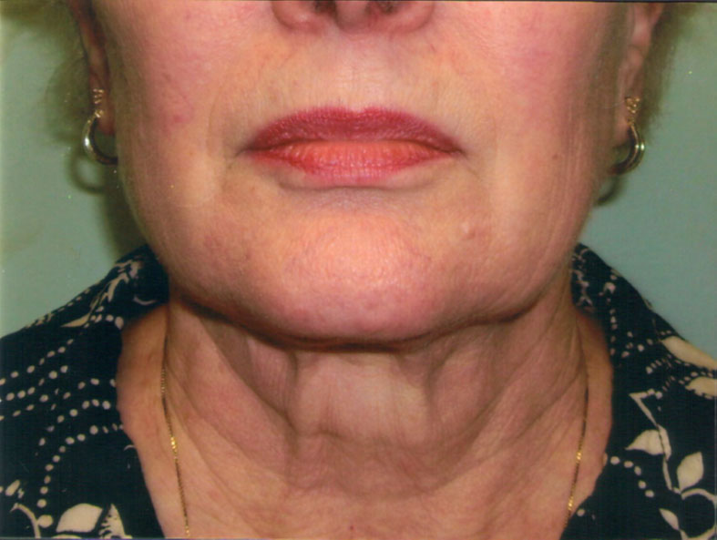 Face/Neck Lift