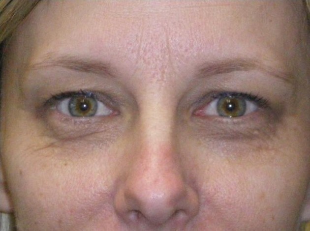 Upper/Lower Lid Blepharoplasty Case 154 Before Photo Upper/Lower Lid Blepharoplasty