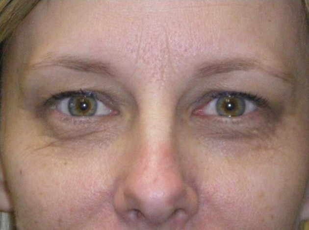 Upper/Lower Lid Blepharoplasty