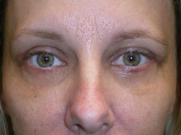 Upper/Lower Lid Blepharoplasty Case 154 After Photo Upper/Lower Lid Blepharoplasty