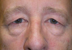 Upper/Lower Lid Blepharoplasty